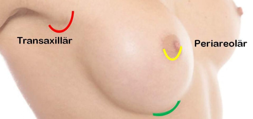 Narben und Schnittführung bei einer Brustvergrößerung